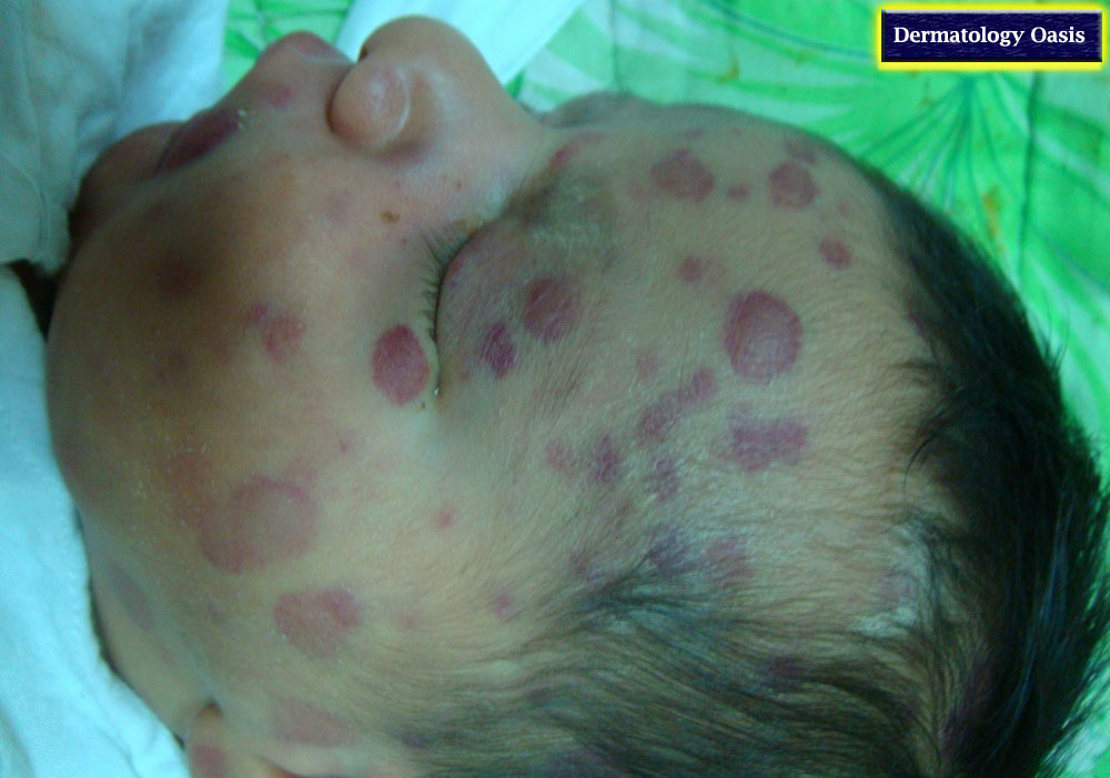 Blueberry Muffin Baby Dermatology Oasis