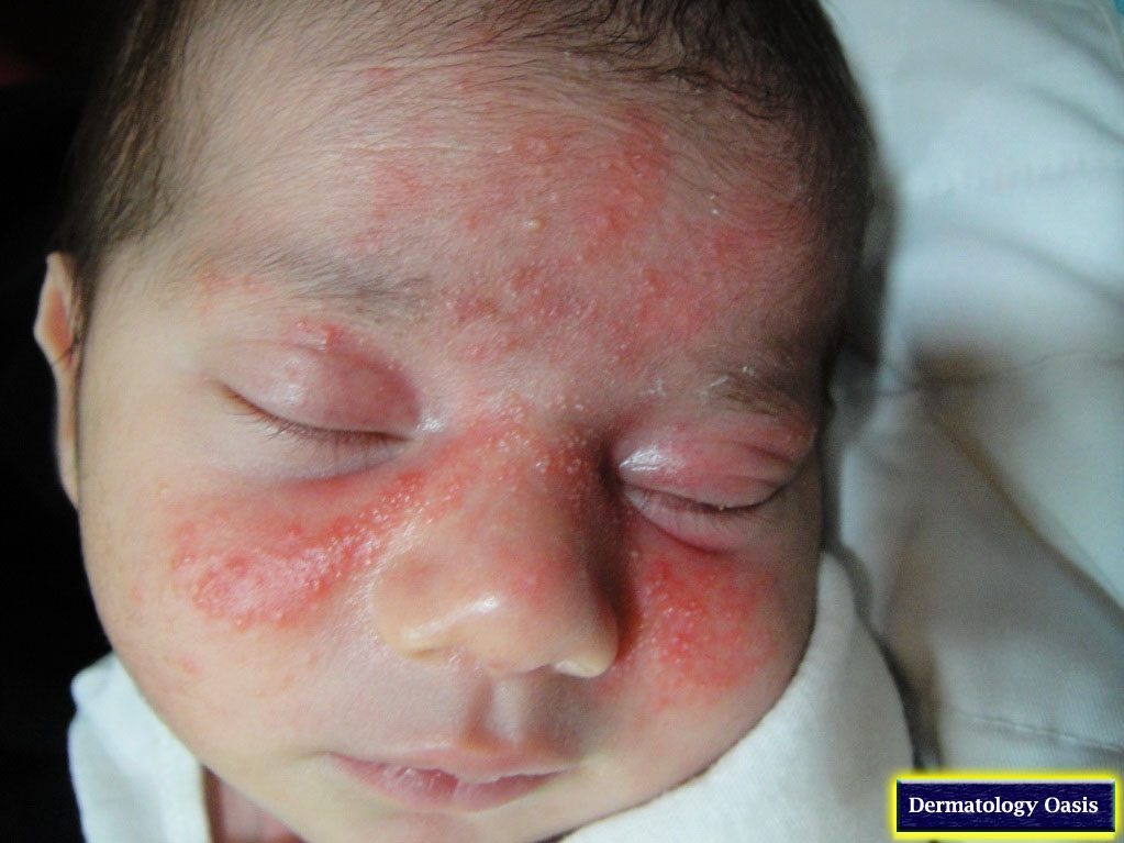 What Causes Pimples on a Baby's Ears? | LIVESTRONG.COM