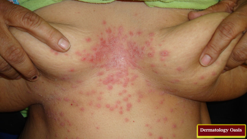 Infant, Toddler and Children, Rashes - Ask Doctor Sears