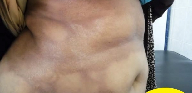 Extensive morphea | Dermatology Oasis