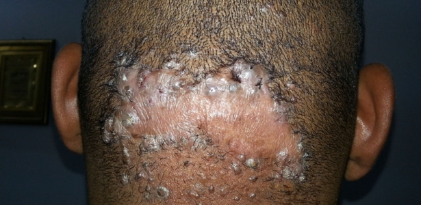 Acne keloidalis nuchae Dermatology Oasis