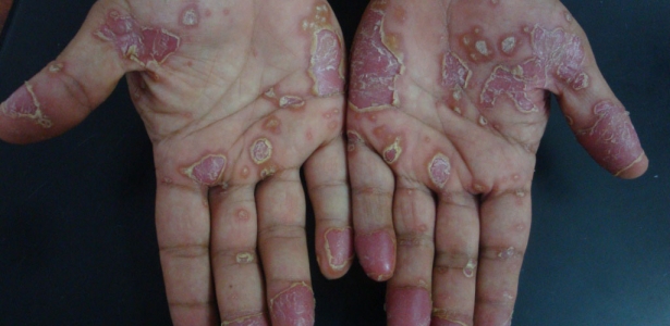 Palmar psoriasis Dermatology Oasis