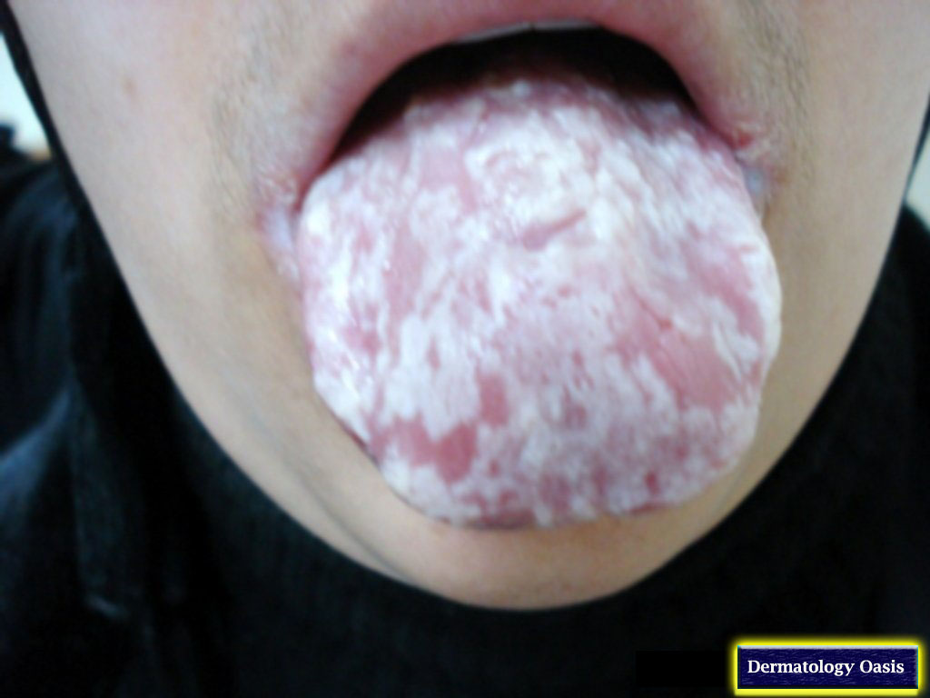 Oral Candidiasis Oral Thrush Causes Pathophysiology S - vrogue.co