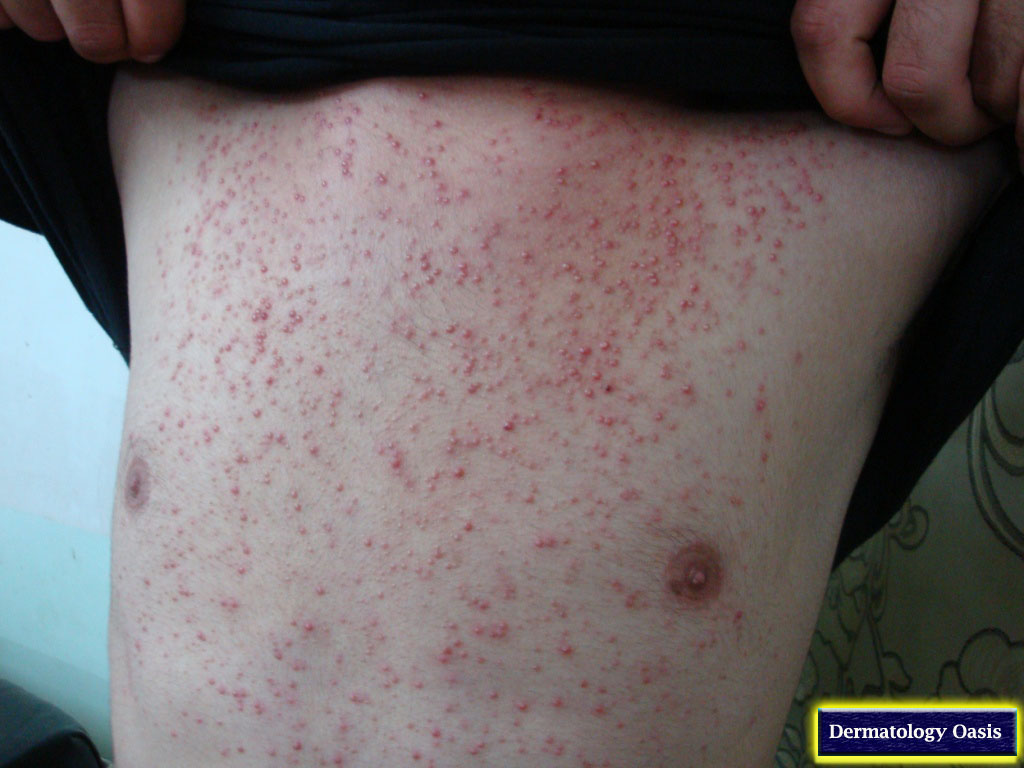 Steroid Injections Cause Acne at Thomas Villarreal blog