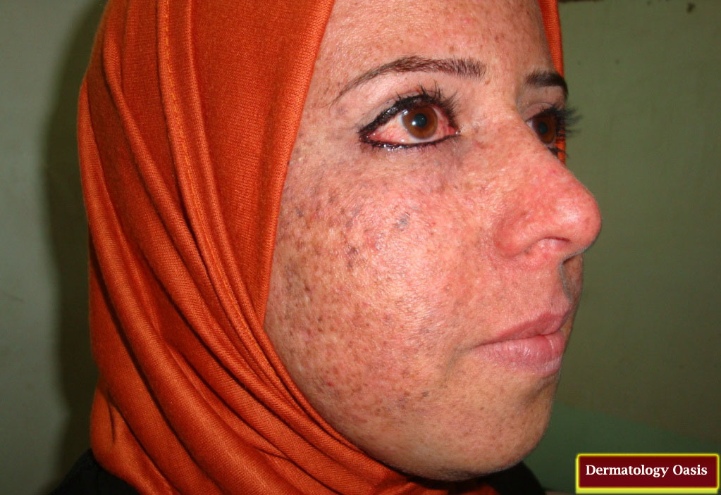 Xeroderma pigmentosum | Dermatology Oasis